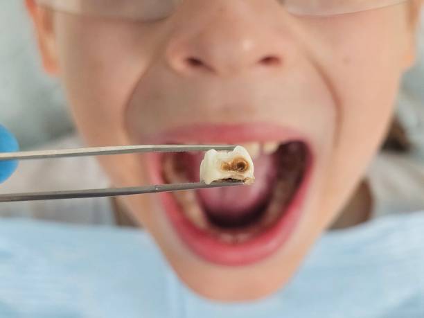 Best Dental Abscess Treatment in Webster City, IA